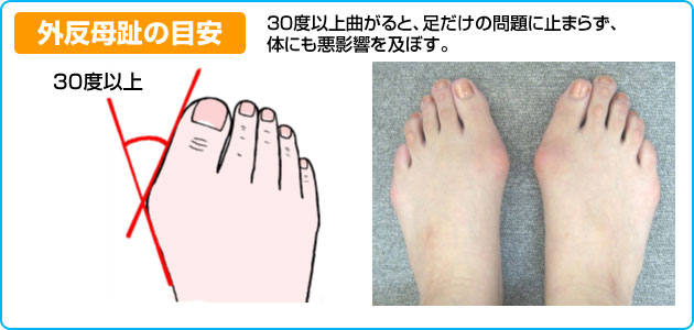 外反母趾の目安：３０度以上曲がると、足だけの問題にとどまらず、体にも悪影響を及ぼす