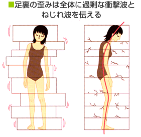 足裏の歪みは全体に過剰な衝撃波とねじれ波を伝える