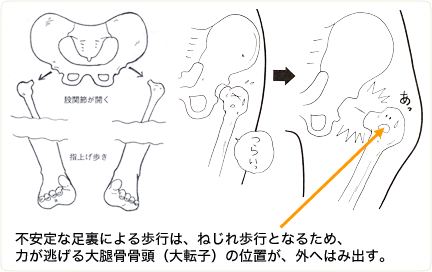 不安定な足裏とねじれ歩行の説明