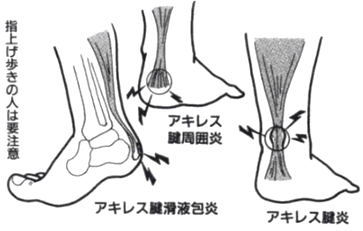 アキレス腱が痛む症状