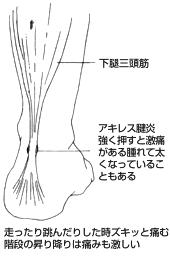 走ったり跳んだりした時ズキッと痛む