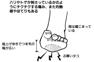 指のつけ根の分厚いタコ