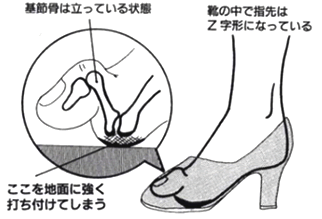 指のつけ根の分厚いタコ