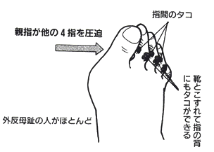 指間のタコによる痛みの症状図