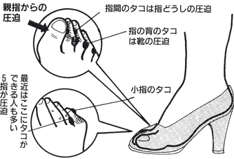 タコができる原因