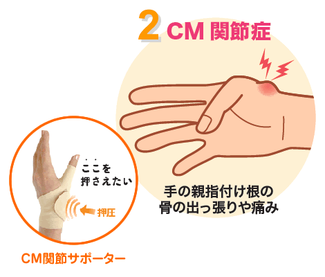 CM関節症