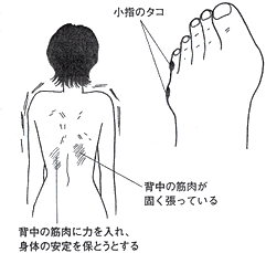 背中の筋肉の疲労