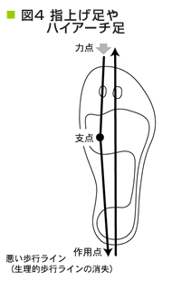 指上げ足やハイアーチ足