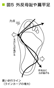 外反母趾や偏平足