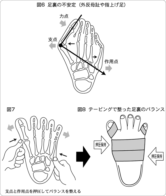 足裏の不安定（外反母趾や指上げ足）