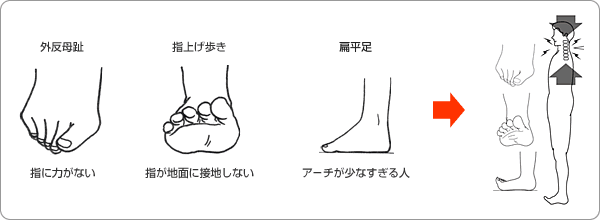 首の異常を追求していくと足裏の不安定にたどりつく