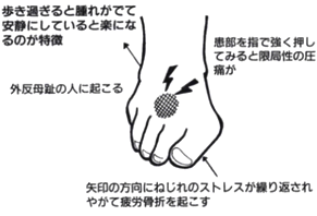 足背部の痛みの症状