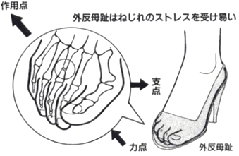 外反母趾はねじれのストレスを受けやすい