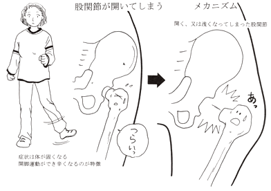  腰、仙腸関節の歪みと「股関節痛」