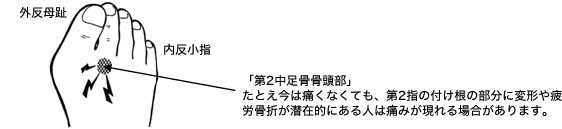 第2中足骨骨頭部に起こる異常