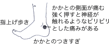 かかとの内側、外側のピリピリした痛み