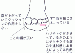 Fourth Hurt 第4指付け根の痛み(モートン病) – 笠原巖公式サイト「足裏天国」フットケアのカサハラページ