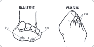 指上げ歩きと外反母趾