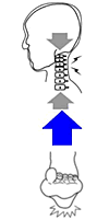 男性に多い群発頭痛