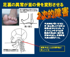 足裏の異常が首の骨を変形させる