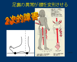 足裏の異常が腰を変形させる