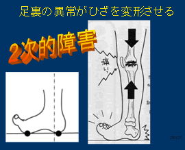 足裏の異常がひざを変形させる