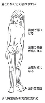 歩く時左足が外方向に流れる