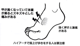 足の甲の痛みの症状