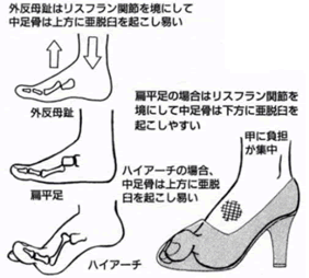 足の甲の痛みの原因