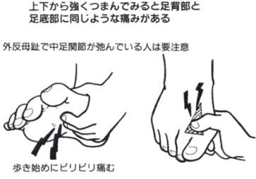 第1・第2中足骨間の痛みの症状