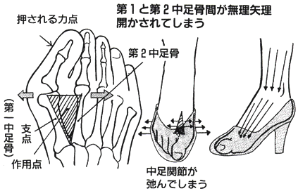 第1・第2中足骨間の痛みの本当の原因