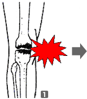 骨の変形から再生までの図(1)