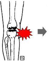 骨の変形から再生までの図(2)