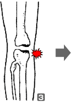 骨の変形から再生までの図(3)