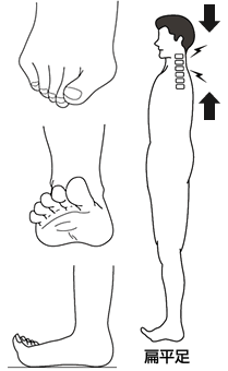 偏平足と首にかかる負担