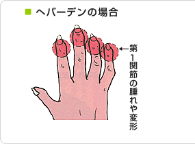 ヘバーデン結節の区別