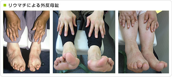 リウマチによる外反母趾の症例