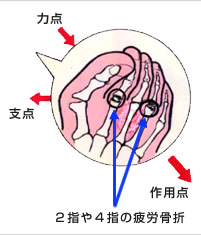 2指や4指の疲労骨折