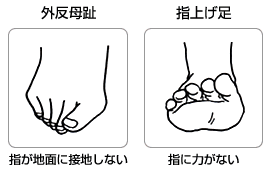 不安定な足裏の例