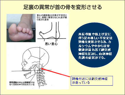 足裏の異常が首の骨を変形させる