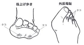 指上げ歩きと外反母趾