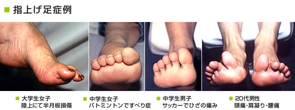 指上げ足症例