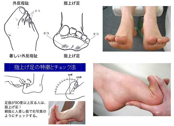 外反母趾や指上げ足の症状例