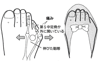 小指のタコと内反小指の痛みの原因
