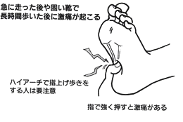 足裏の痛みの症状