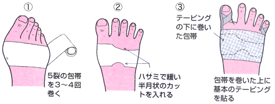 痛みのある場合のテーピング法