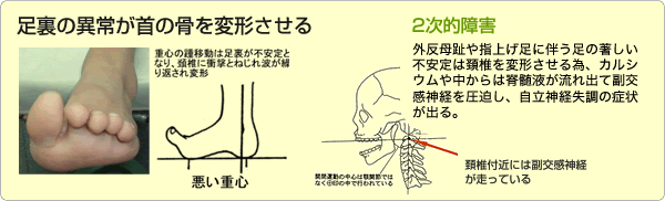 足裏の異常が首の骨を変形させる