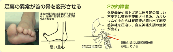 外反母趾や指上げ足の症状例