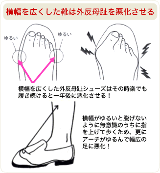 横幅を広くした靴は外反母趾を悪化させる