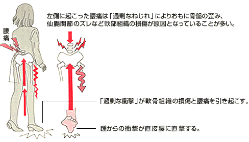 腰痛の原因図解